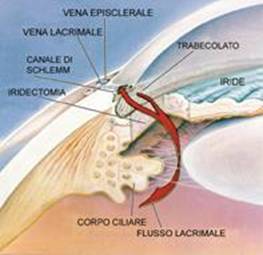 Glaucoma